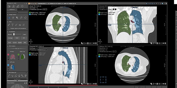 Intrasense met à disposition son nouveau protocole de visualisation scanner, dédié au Covid-19.