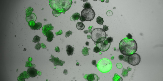 Au CRCM, les jumeaux cliniques de cellules cancéreuses (ou organoïdes) permettent de personnaliser les traitements et de tester de nouvelles molécules