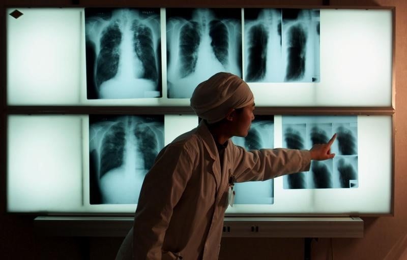 Pour l'oms, la tuberculose tue moins mais elle  ne le devrait pas autant