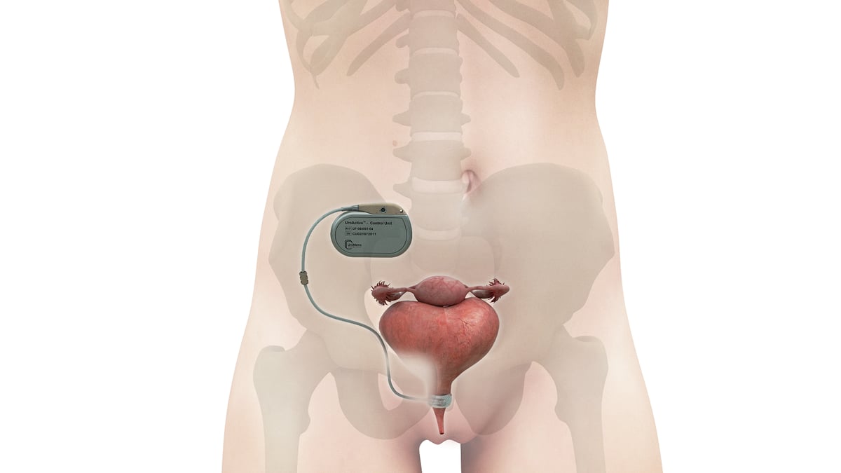 Uromems est sur le point d'enclencher la phase clinique pivot pour les hommes.