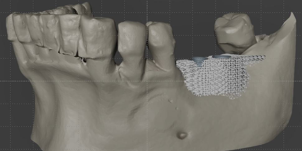 A Montpellier, Kervalion a trouvé comment modéliser un greffon d'os en 3D pour les poses d'implants nécessitant un complément osseux.