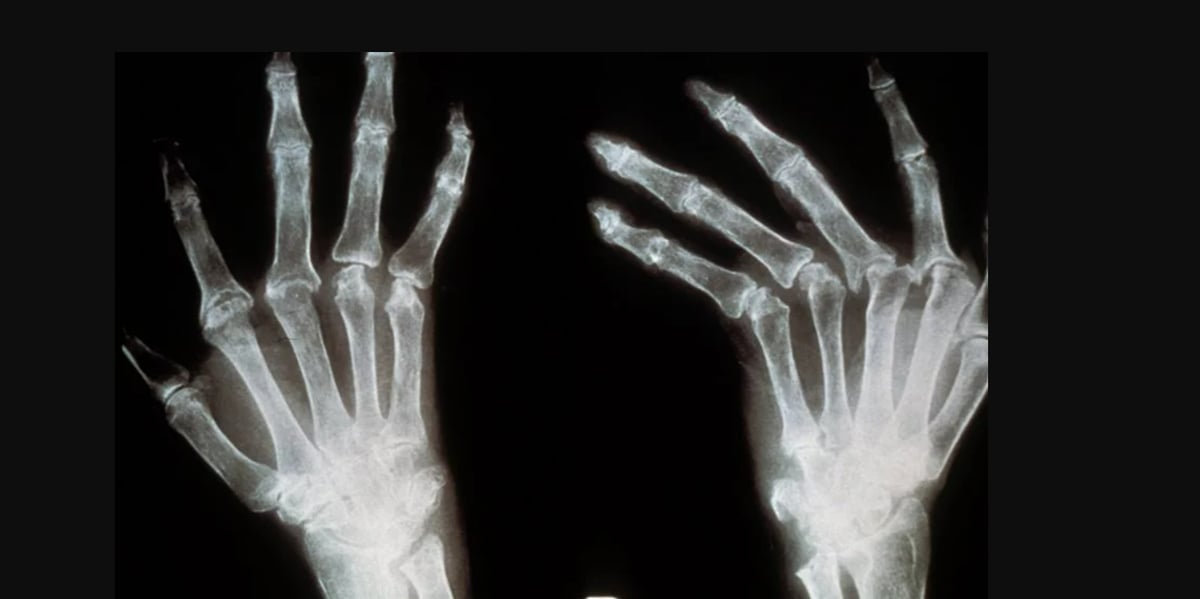 La biotech toulousaine Arthritis4Cure souhaite lancer les phases cliniques de son biomédicament