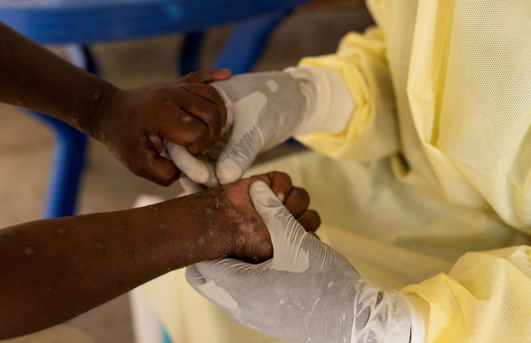 Une infirmiere preleve un echantillon sur un enfant declare suspect de mpox au centre de traitement de munigi