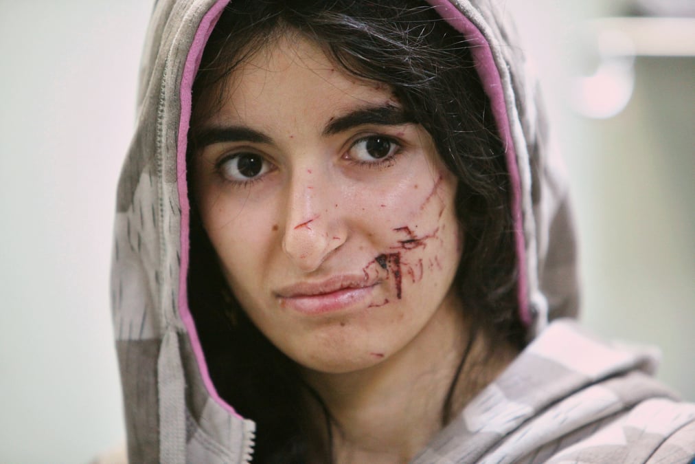 A displaced woman who was injured in clashes and fleeing from islamic state militants of mosul, receives treatment at a hospital west of erbil