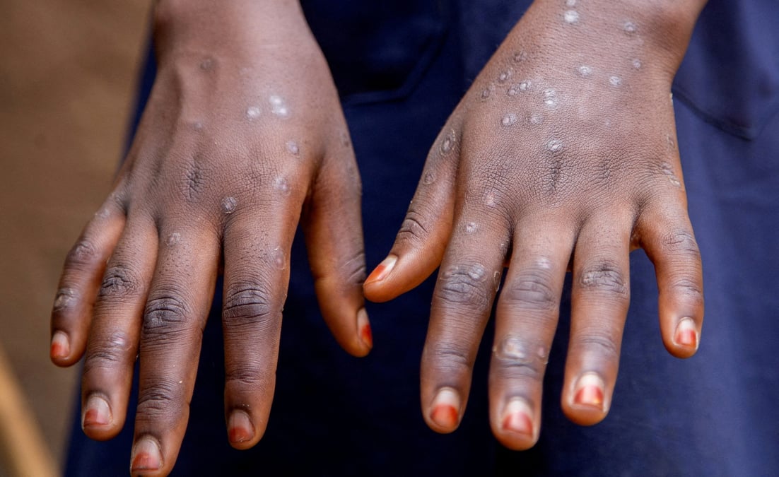 Un cas de mpox au burundi