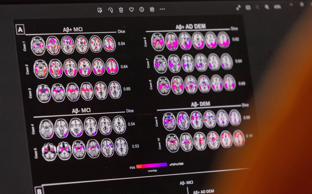 Un scientifique examine les schémas hypométaboliques et d’hypoperfusion chez un patient atteint de la maladie d’Alzheimer.