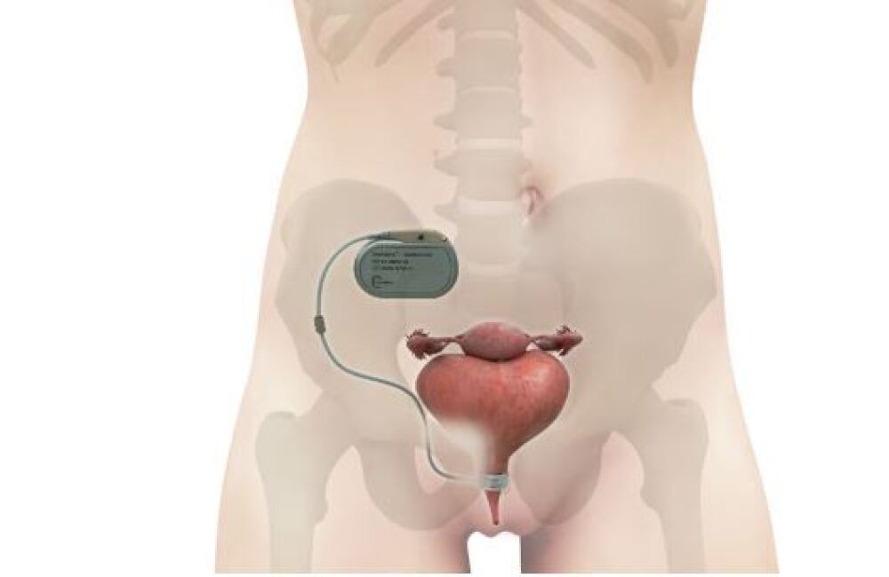 Uromems veut devenir la référence du traitement des fuites urinaires d'effort.