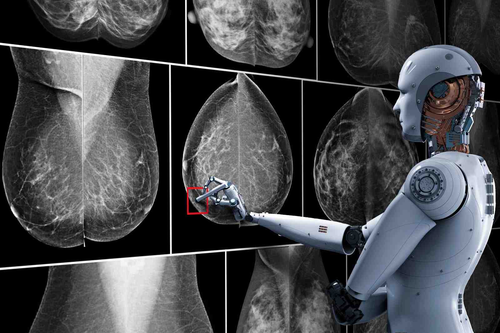 Mammographie