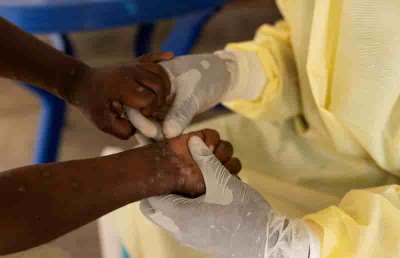 Le mpox est une maladie virale qui cause des éruptions cutanées, de la fièvre, et parfois des douleurs articulaires.