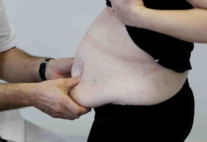 Des mesures a l'etude pour reduire l'obesite