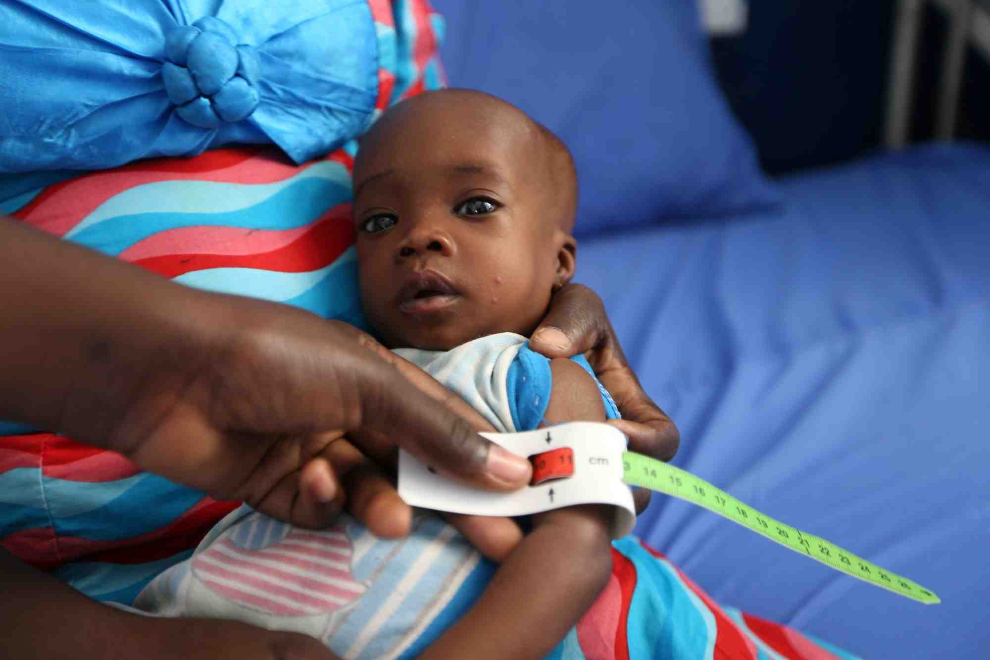 Photo d'archives du depistage de la malnutrition chez les enfants dans l'hopital general molai