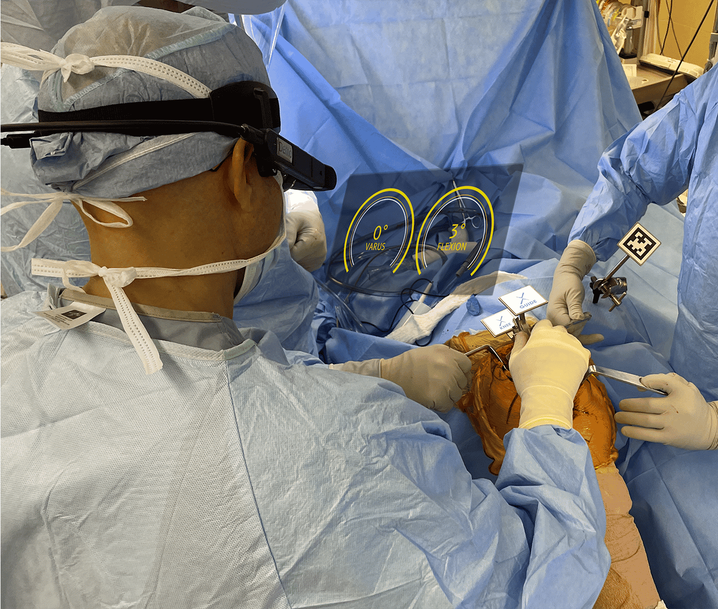 Un chirurgien américain opérant avec les lunettes augmentées Pixee Medical