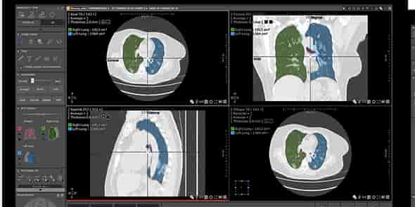 Intrasense met à disposition son nouveau protocole de visualisation scanner, dédié au Covid-19.