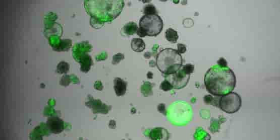 Au CRCM, les jumeaux cliniques de cellules cancéreuses (ou organoïdes) permettent de personnaliser les traitements et de tester de nouvelles molécules