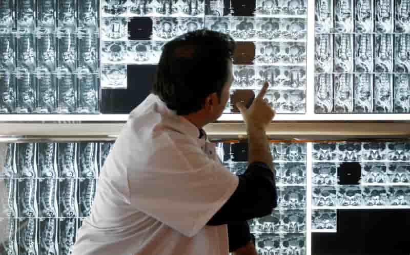 Le cancer serait souvent du a un "manque de chance"