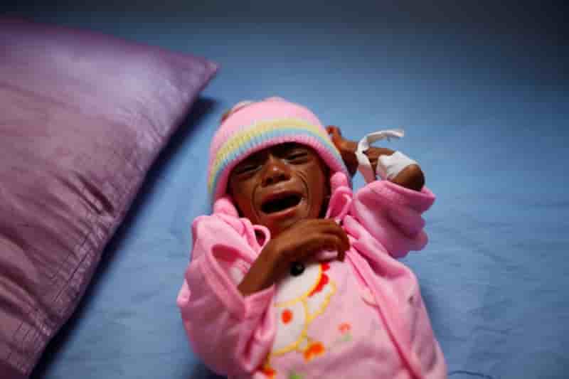 Malnutrition infantile en hausse au yemen a cause de la guerre
