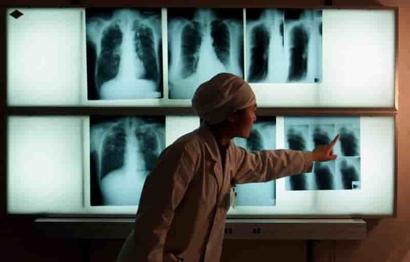 Pour l'oms, la tuberculose tue moins mais elle ne le devrait pas autant
