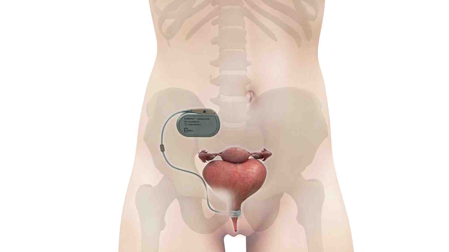 Uromems est sur le point d'enclencher la phase clinique pivot pour les hommes.