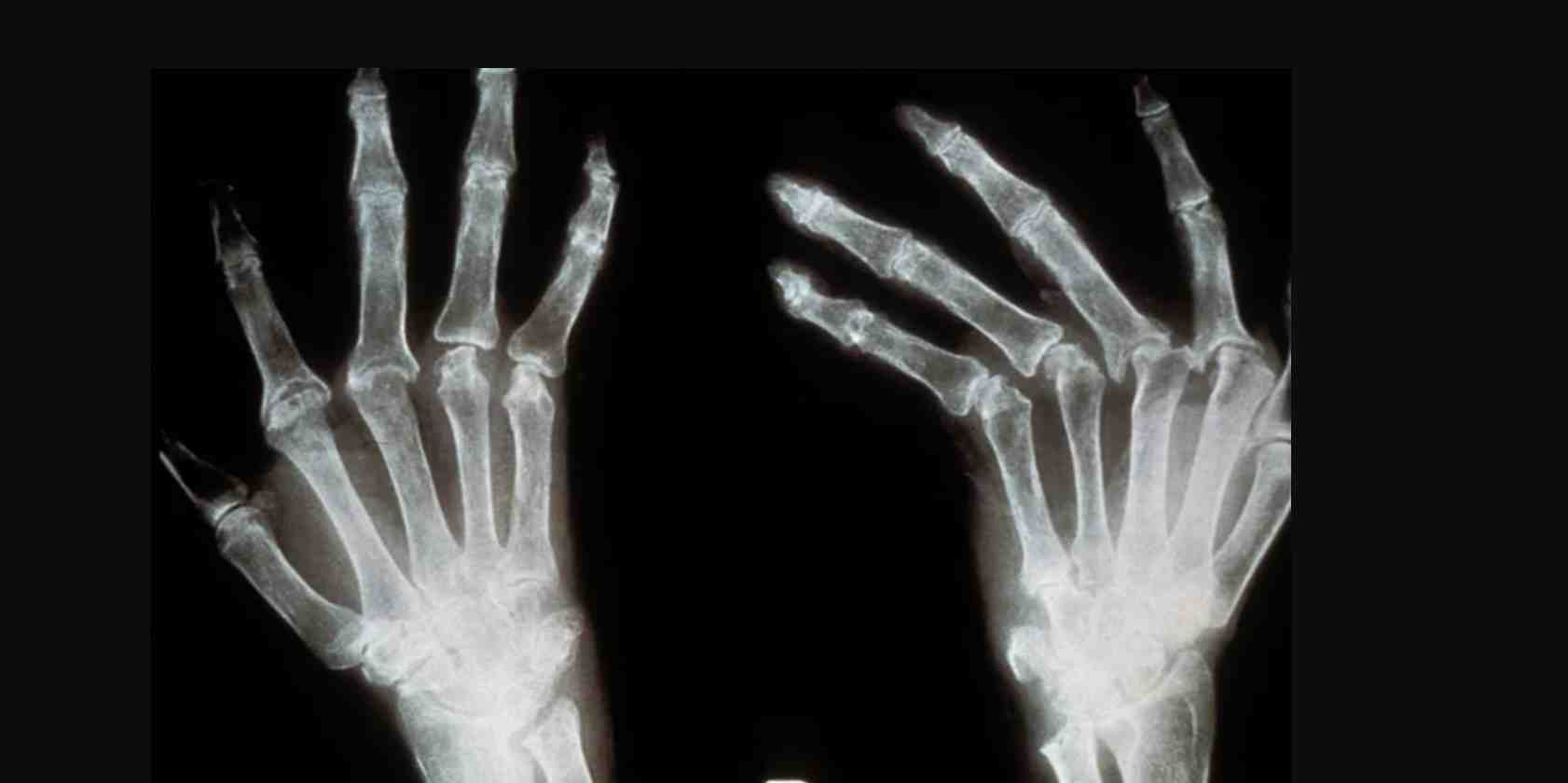 La biotech toulousaine Arthritis4Cure souhaite lancer les phases cliniques de son biomédicament