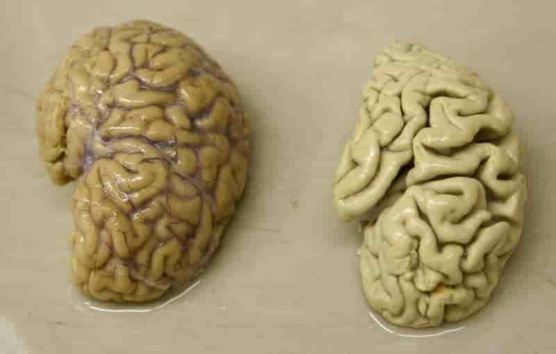 Revers pour le traitement experimental de la maladie d'alzheimer