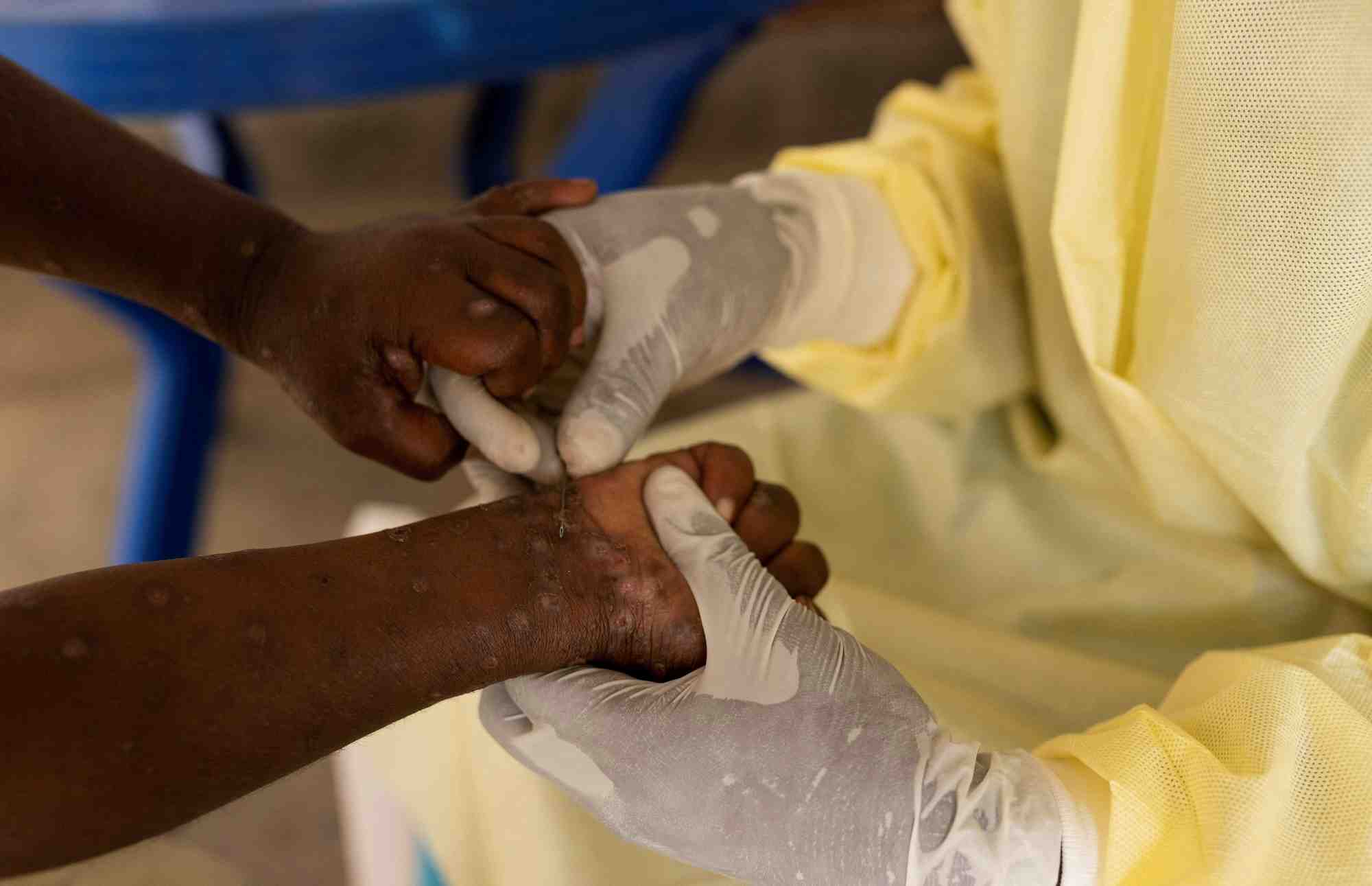 Une infirmiere preleve un echantillon sur un enfant declare suspect de mpox au centre de traitement de munigi