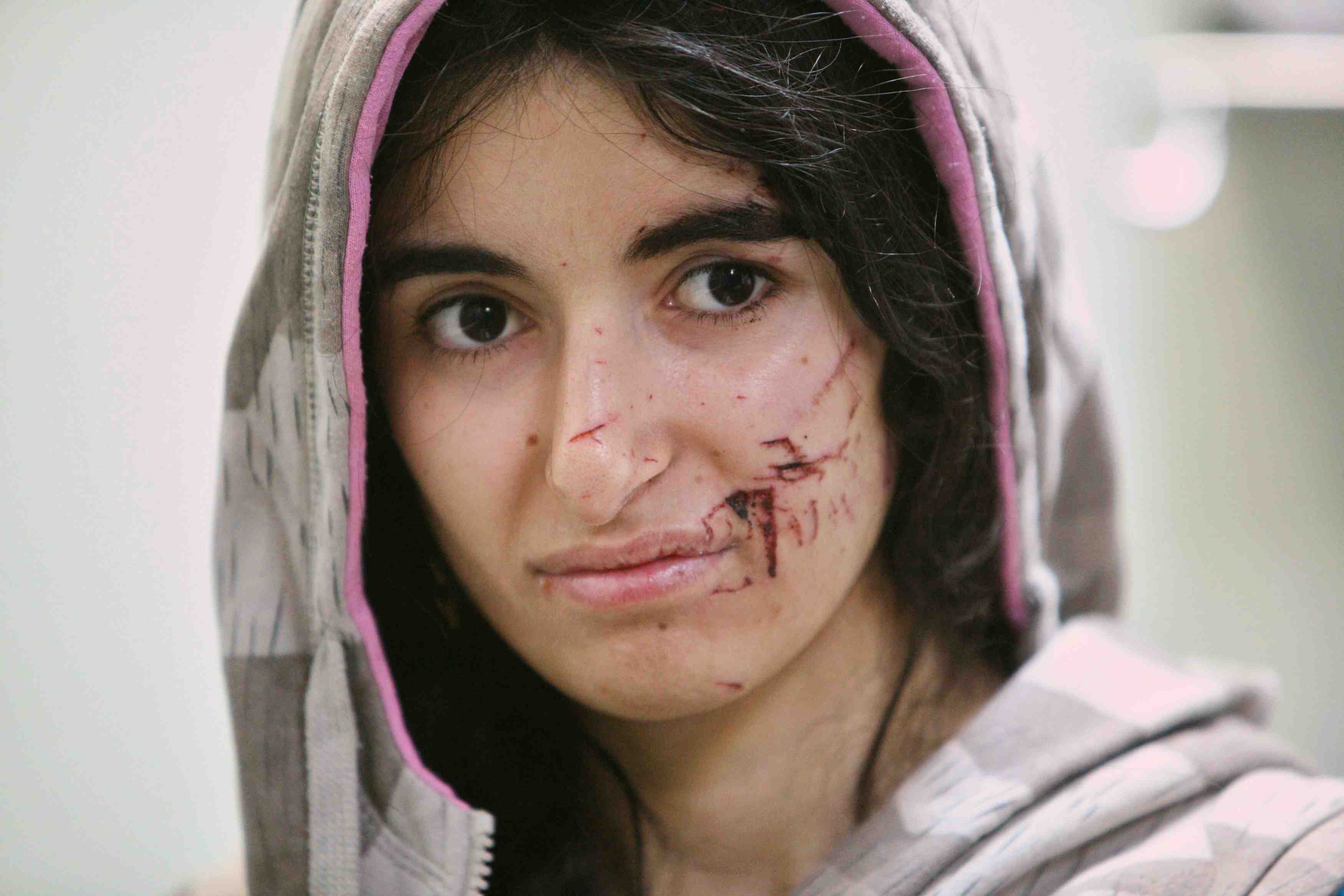 A displaced woman who was injured in clashes and fleeing from islamic state militants of mosul, receives treatment at a hospital west of erbil