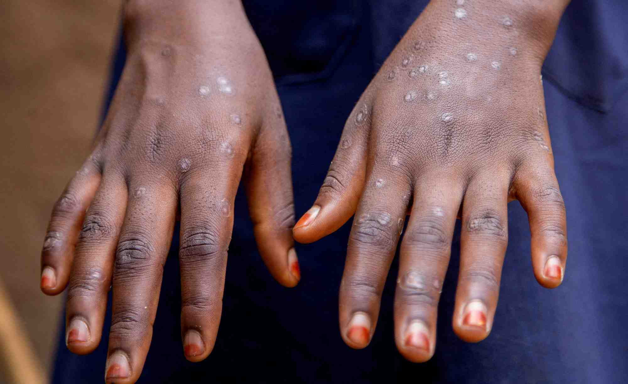 Un cas de mpox au burundi
