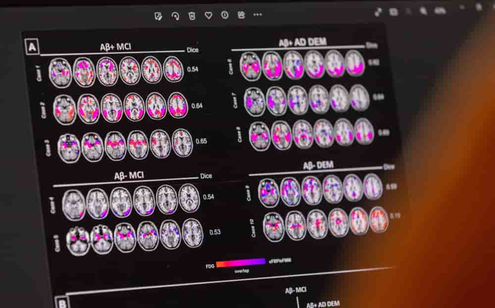 Un scientifique examine les schémas hypométaboliques et d’hypoperfusion chez un patient atteint de la maladie d’Alzheimer.