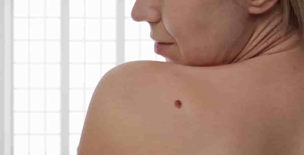 Chaque année, entre 140 000 et 240 000 cas de cancers de la peau sont diagnostiqués en France.